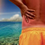 How to Stop Sunburn Itch