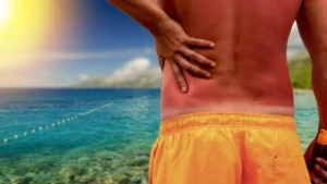 How to Stop Sunburn Itch