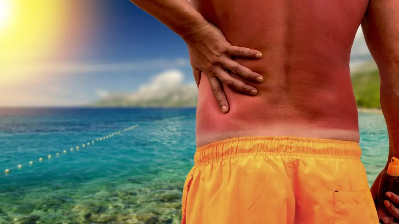 How to Stop Sunburn Itch?