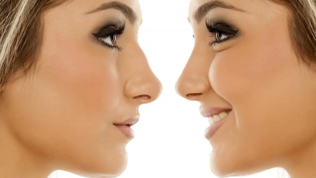 Rhinoplasty: A Popular and Complex Facial Plastic Surgery